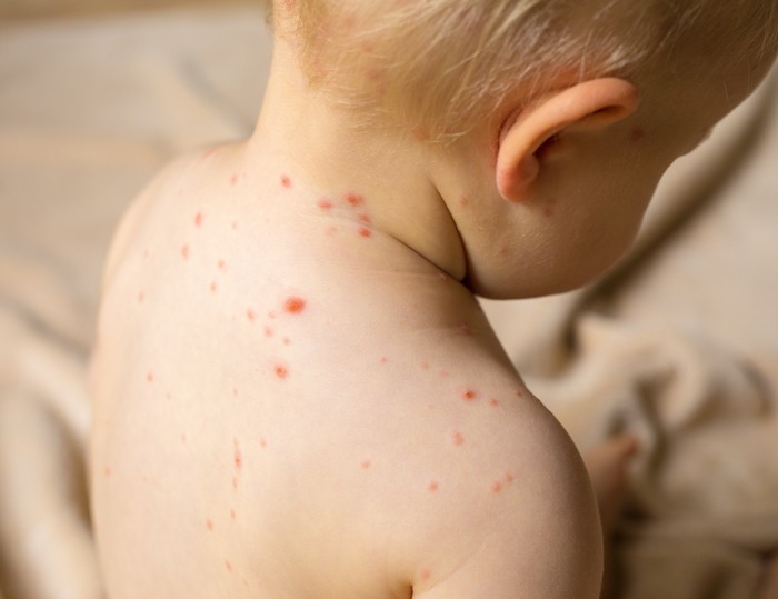 水痘高峰期 及早預防