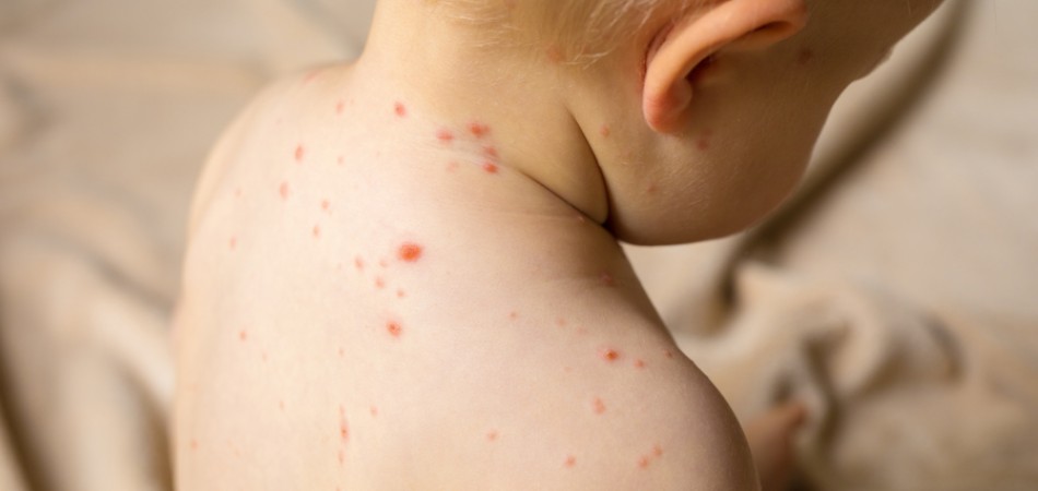 水痘高峰期 及早預防
