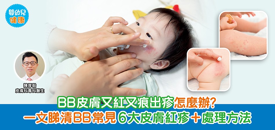 嬰幼兒健康|BB皮膚又紅又痕出疹?怎麼辦?一文睇清BB常見6大皮膚紅疹+處理方法 嬰幼兒健康|BB皮膚又紅又痕出疹?怎麼辦?一文睇清BB常見6大皮膚紅疹+處理方法